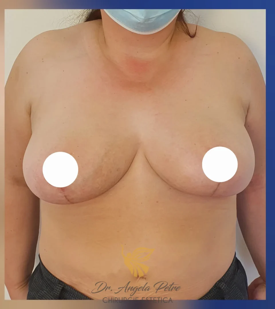 Caz 06 Reducție mamară (micșorare sâni), frontal, after, Dr. Angela Petre - București