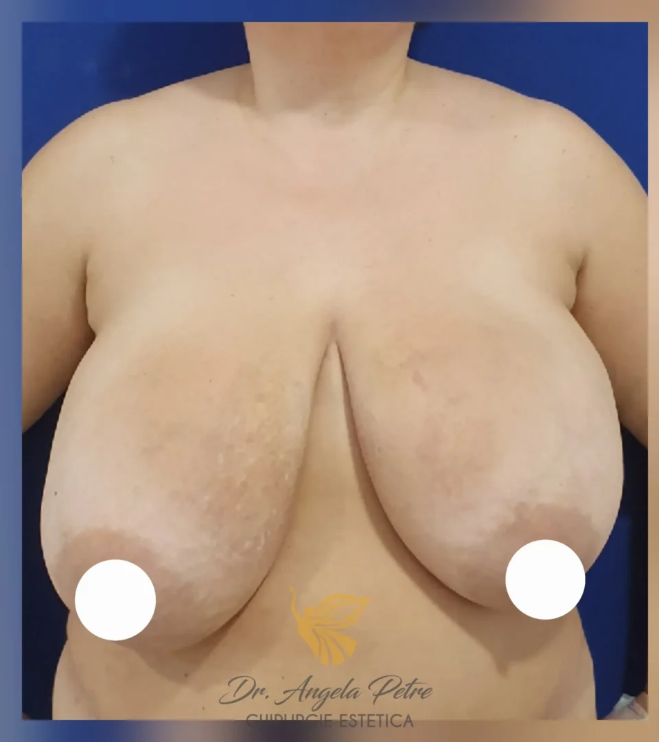 Caz 06 Reducție mamară (micșorare sâni), frontal, before, Dr. Angela Petre - București