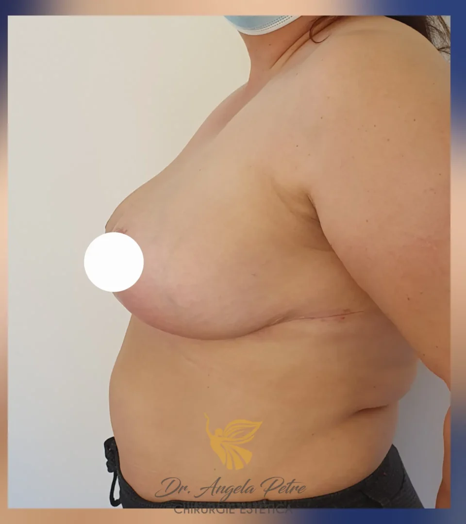 Caz 06 Reducție mamară (micșorare sâni), profil, after, Dr. Angela Petre - București