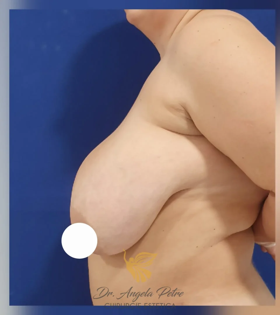 Caz 06 Reducție mamară (micșorare sâni), profil, before, Dr. Angela Petre - București