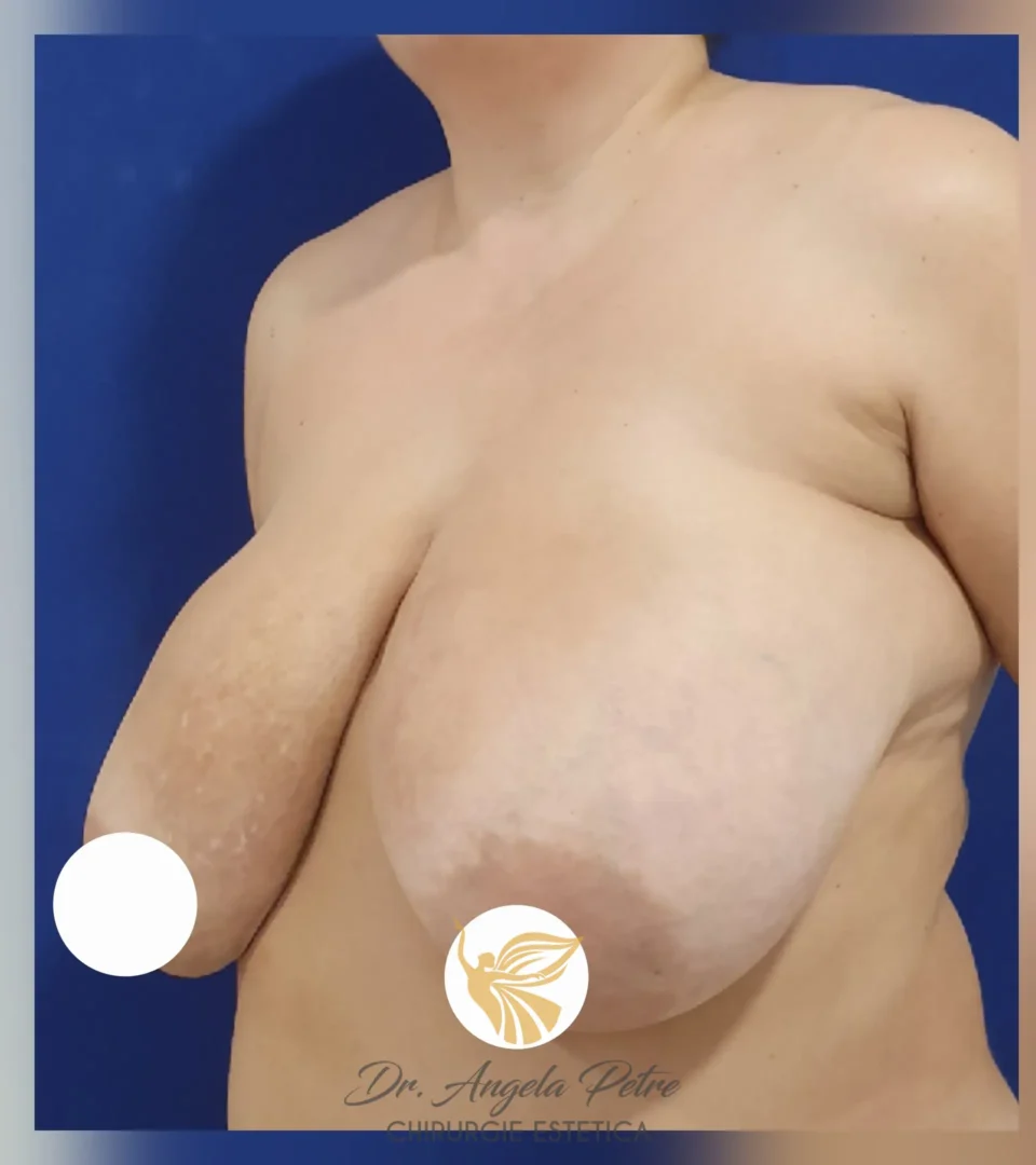 Caz 06 Reducție mamară (micșorare sâni), semiprofil, before, Dr. Angela Petre - București
