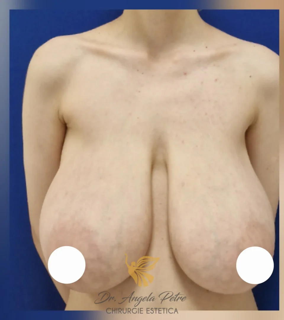 Caz 07 Reducție mamară (micșorare sâni), frontal, before, Dr. Angela Petre - București
