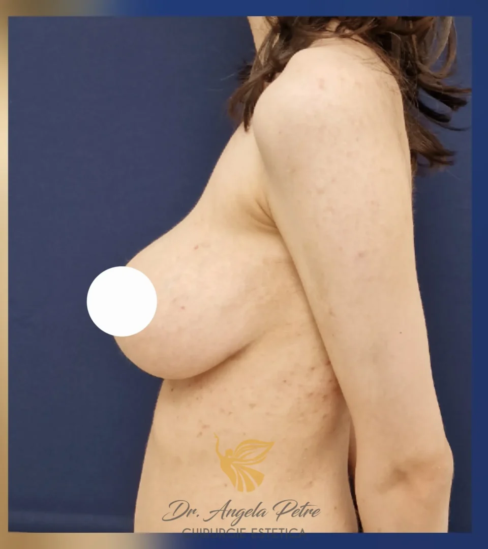 Caz 07 Reducție mamară (micșorare sâni), profil, after, Dr. Angela Petre - București