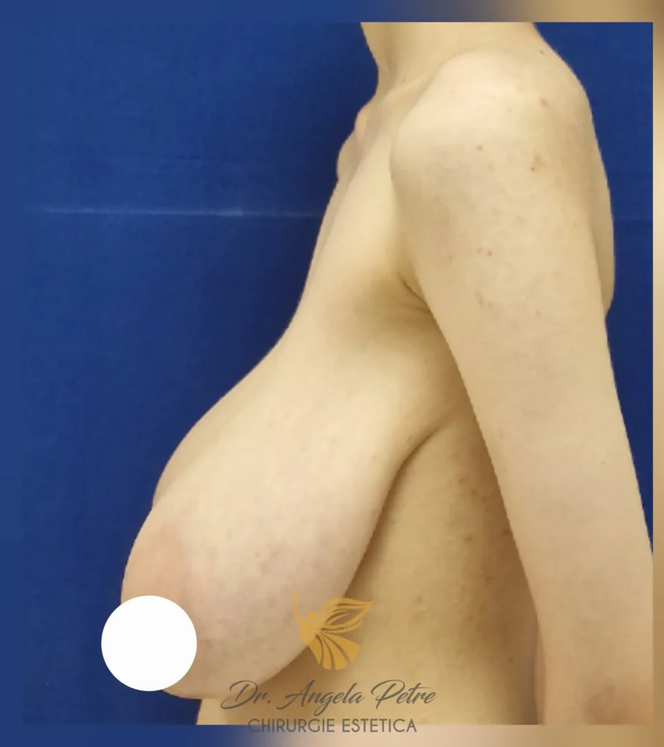 Caz 07 Reducție mamară (micșorare sâni), profil, before, Dr. Angela Petre - București