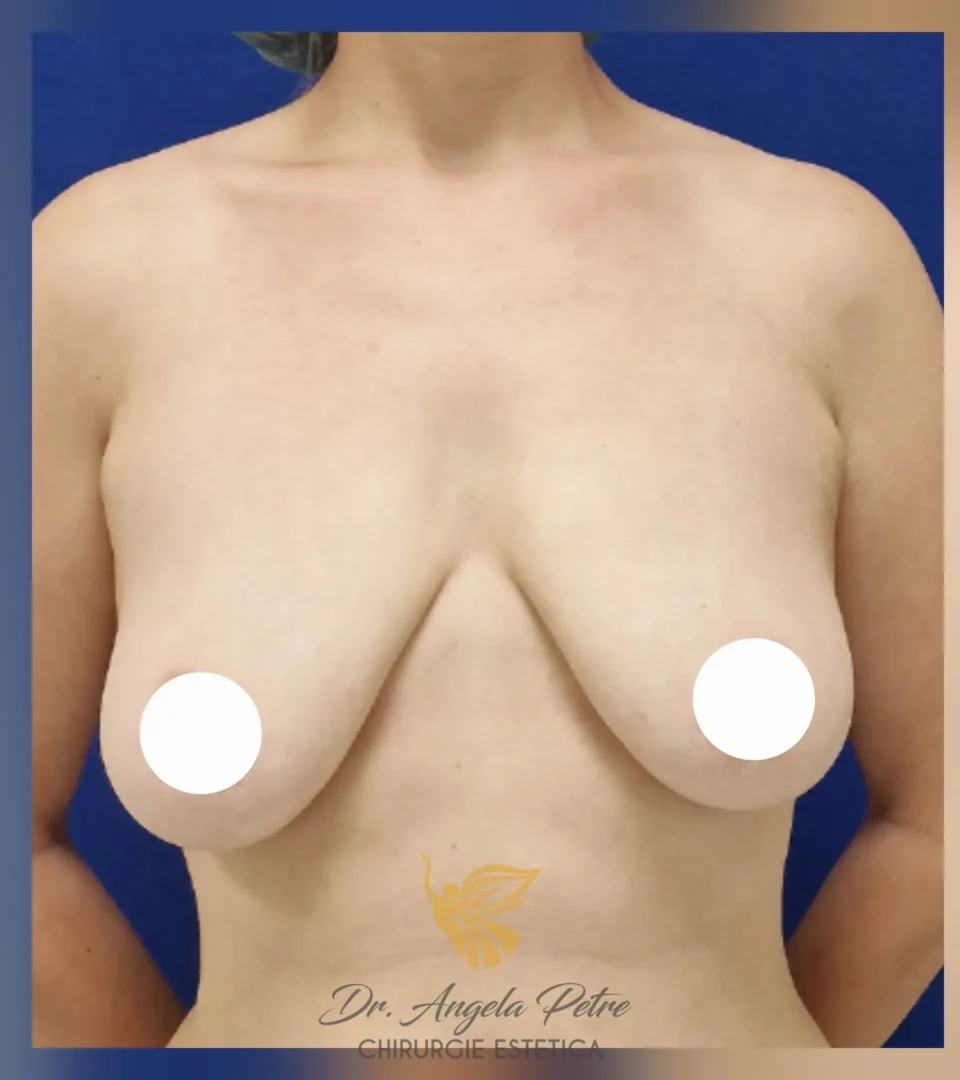 Caz 08 Reducție mamară (micșorare sâni), frontal, before, Dr. Angela Petre - București