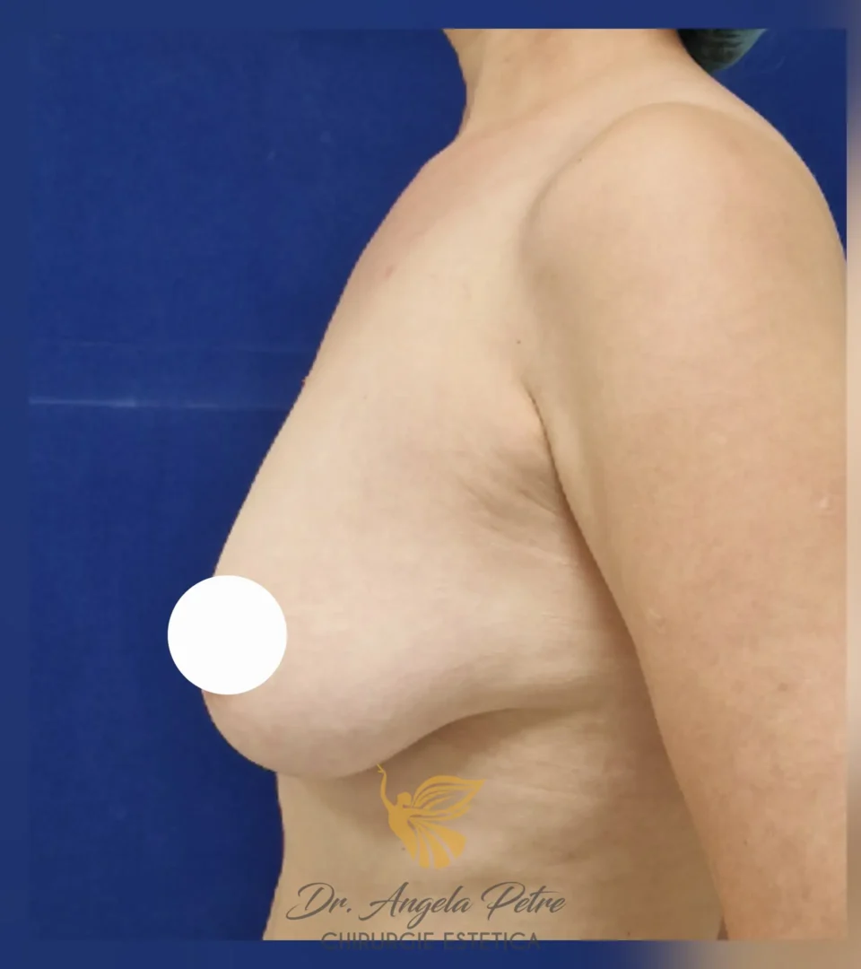 Caz 08 Reducție mamară (micșorare sâni), profil, before, Dr. Angela Petre - București