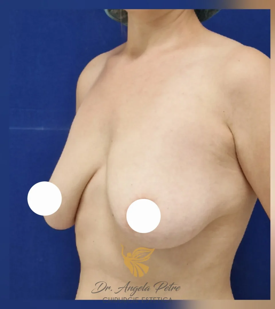 Caz 08 Reducție mamară (micșorare sâni), semiprofil, before, Dr. Angela Petre - București