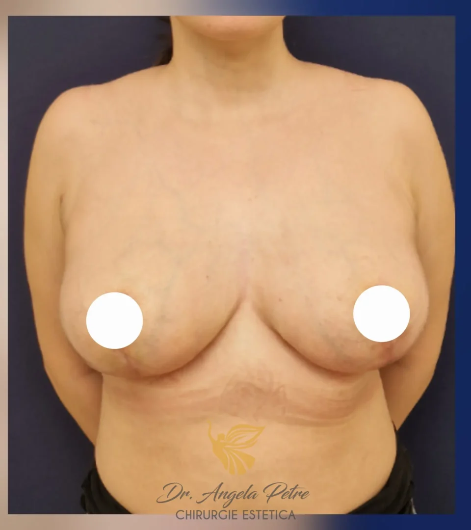 Caz 09 Reducție mamară (micșorare sâni), frontal, after, Dr. Angela Petre - București
