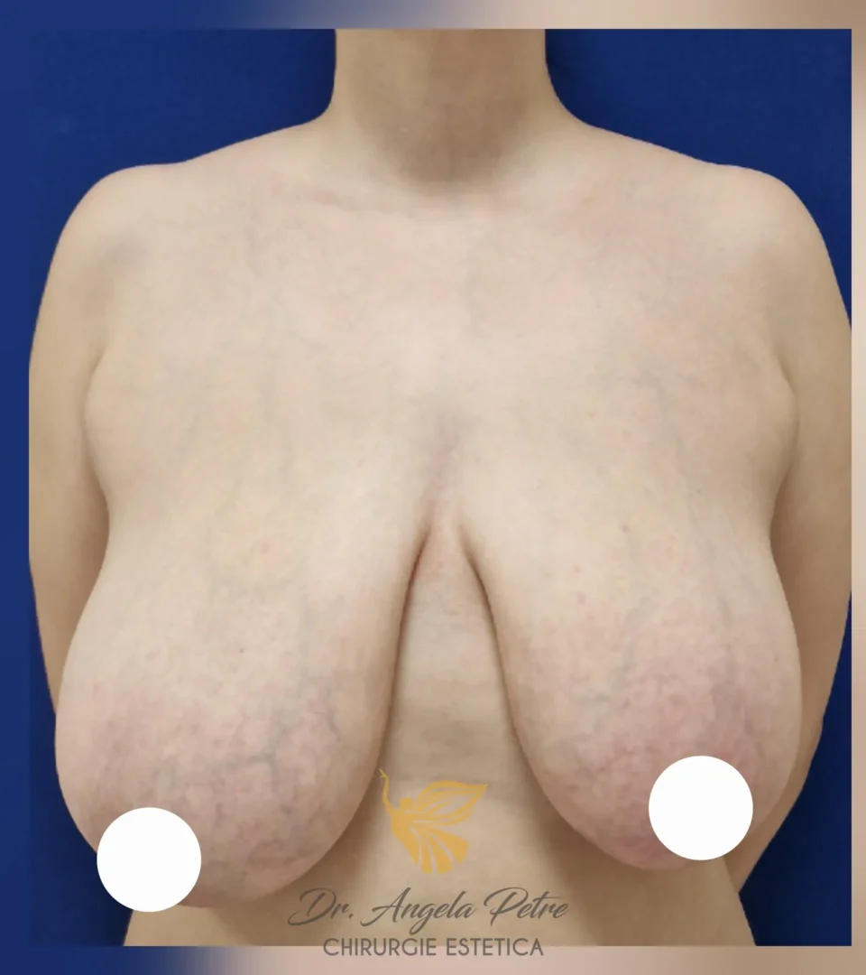 Caz 09 Reducție mamară (micșorare sâni), frontal, before, Dr. Angela Petre - București