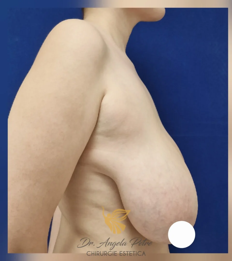 Caz 09 Reducție mamară (micșorare sâni), profil, before, Dr. Angela Petre - București