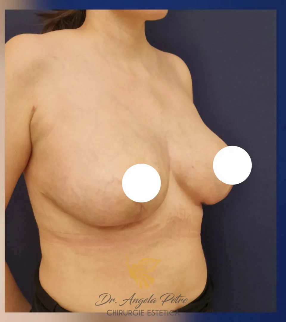 Caz 09 Reducție mamară (micșorare sâni), semiprofil, after, Dr. Angela Petre - București