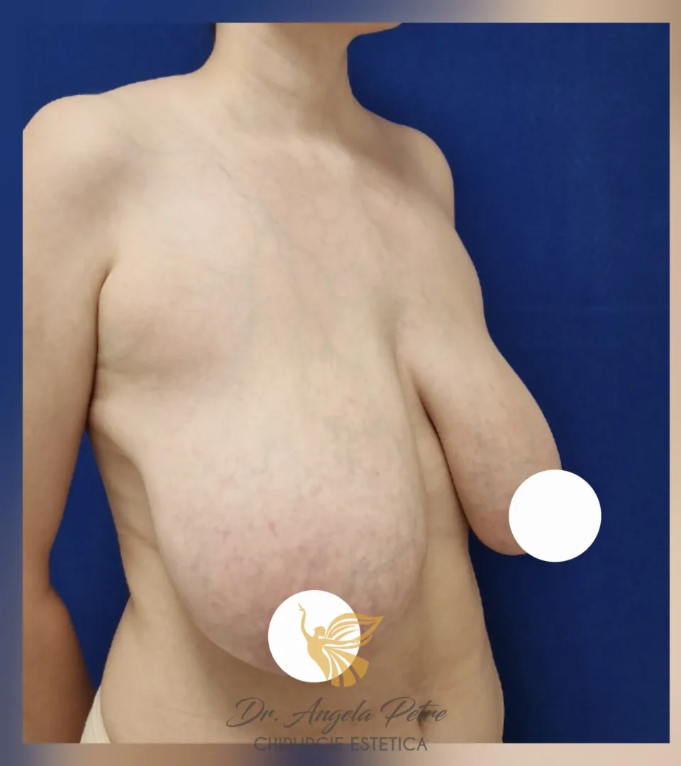 Caz 09 Reducție mamară (micșorare sâni), semiprofil, before, Dr. Angela Petre - București